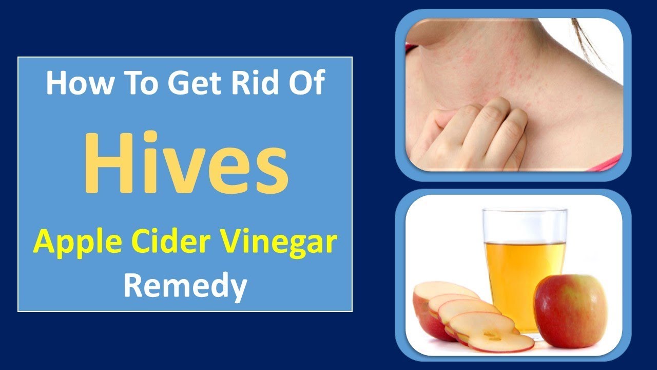 apple cider vinegar for hives home remedies for hives turmeric remedy