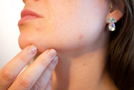 Acv for acne e types and treatment