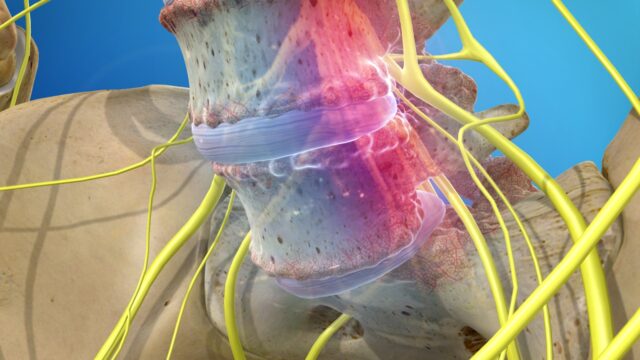 stenosis